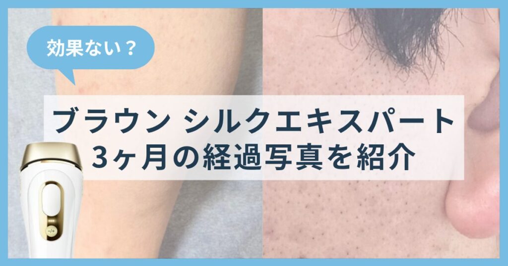 ブラウン シルクエキスパートは効果ない？3ヶ月の経過写真と感想を紹介