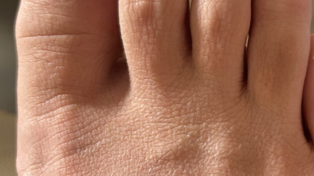 Ulike Air10で夫の指の毛を脱毛-After写真