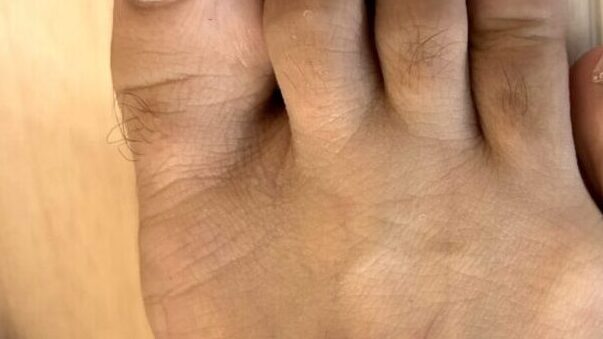 Ulike Air10で夫の指の毛を脱毛-Before写真