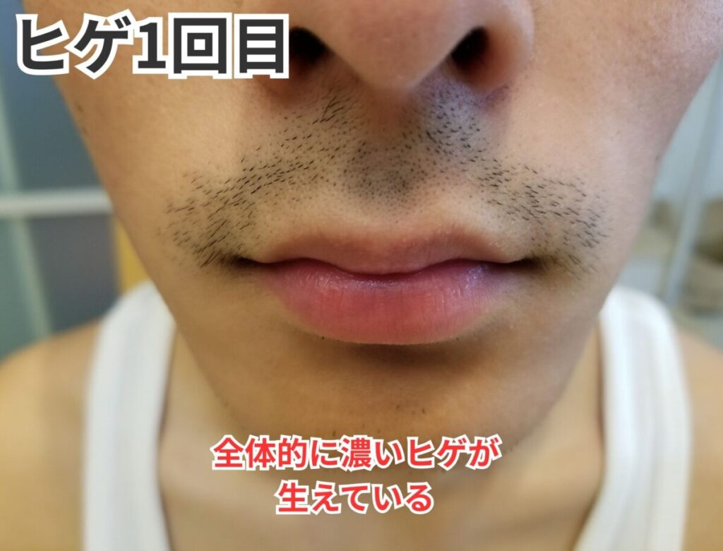 ヒゲ脱毛1回目画像