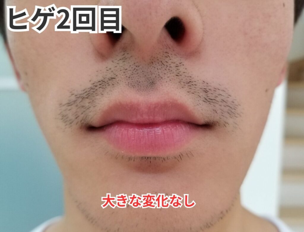 ヒゲ脱毛2回目画像