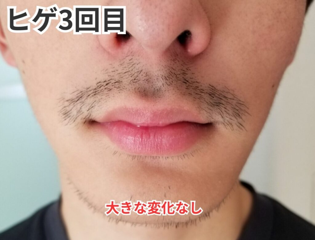 ヒゲ脱毛3回目画像