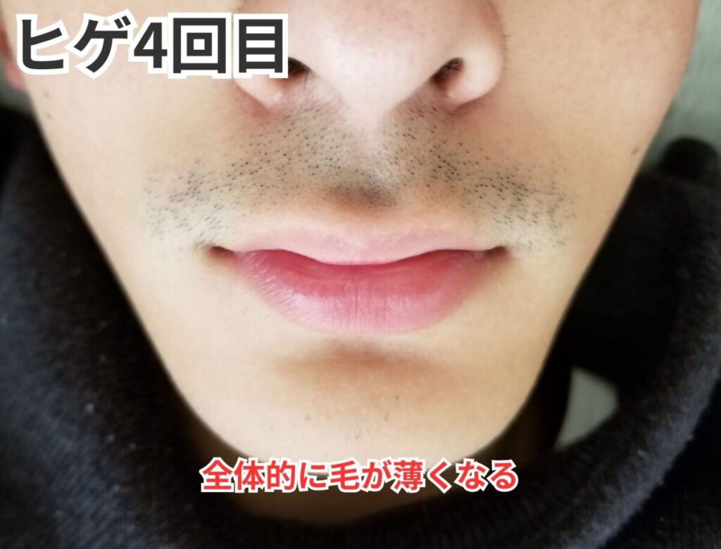 ヒゲ脱毛4回目画像