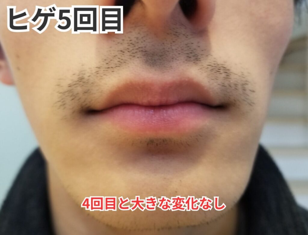 ヒゲ脱毛5回目画像