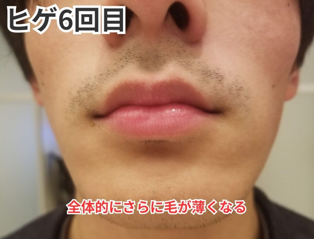 ヒゲ脱毛6回目画像