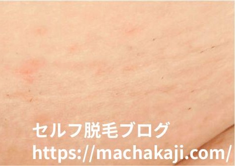 ケノンでVIO脱毛7回目のムダ毛の状態(アフター)