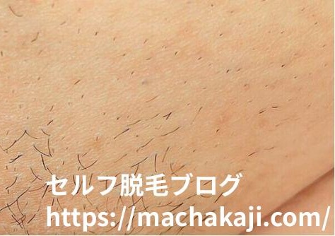 ケノンでVIO脱毛2回目のムダ毛の状態(ビフォー)