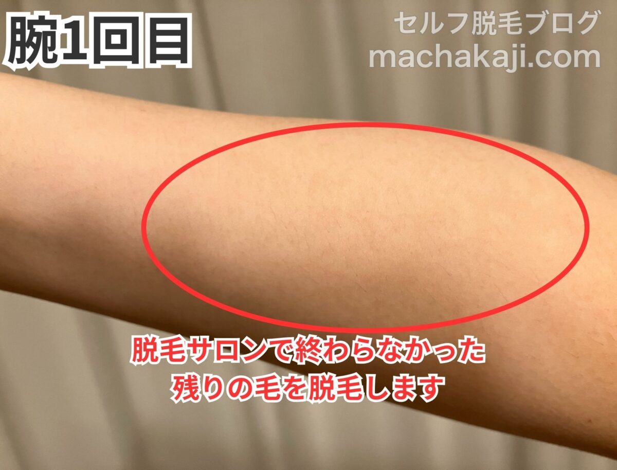 レイボーテヴィーナスで腕を1回照射した経過写真
