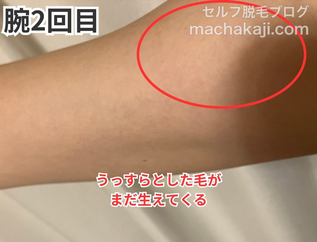 レイボーテヴィーナスで腕を2回照射した経過写真