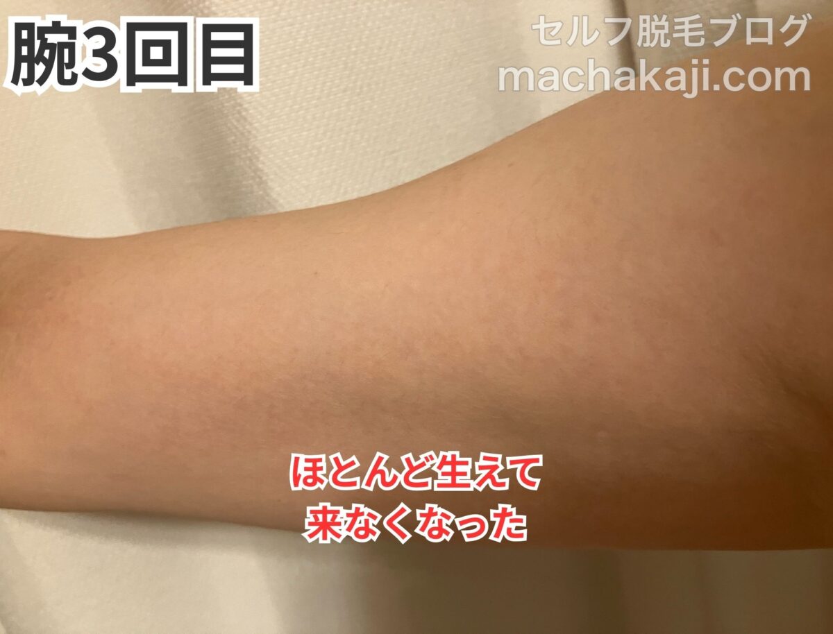 レイボーテヴィーナスで腕を3回照射した経過写真