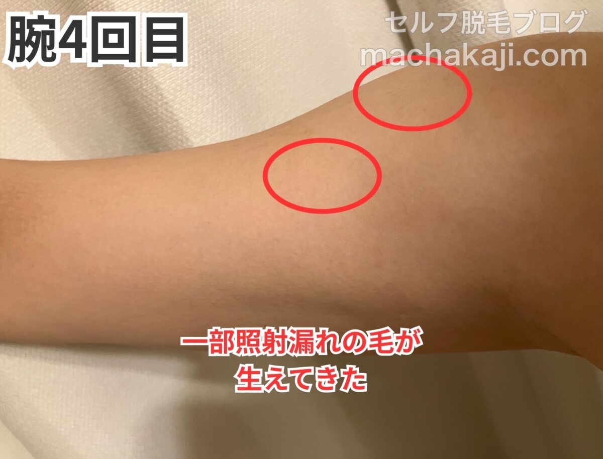 レイボーテヴィーナスで腕を4回照射した経過写真