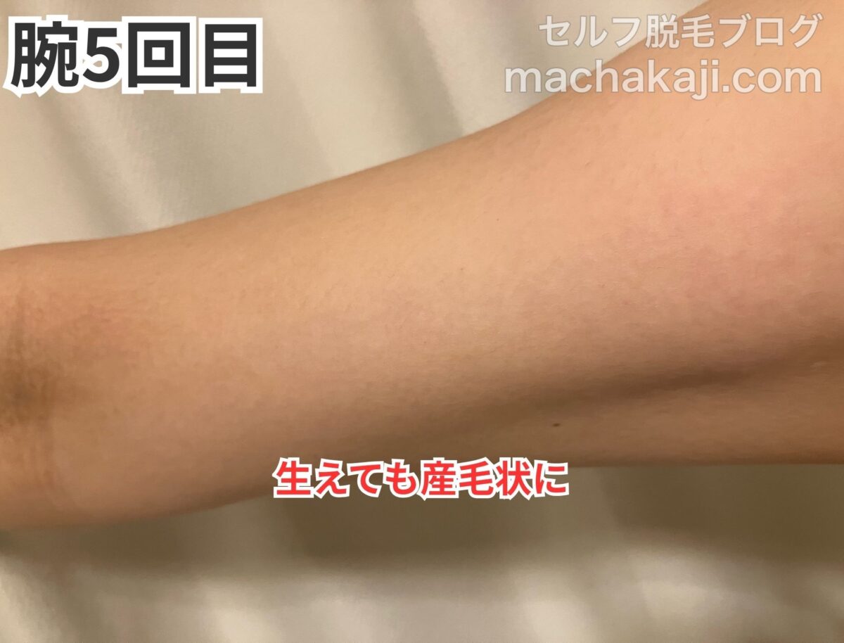 レイボーテヴィーナスで腕を5回照射した経過写真