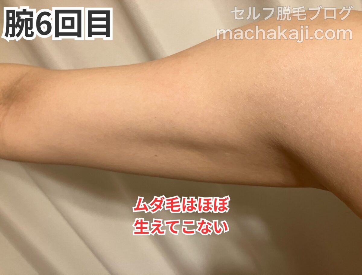 レイボーテヴィーナスで腕を6回照射した経過写真