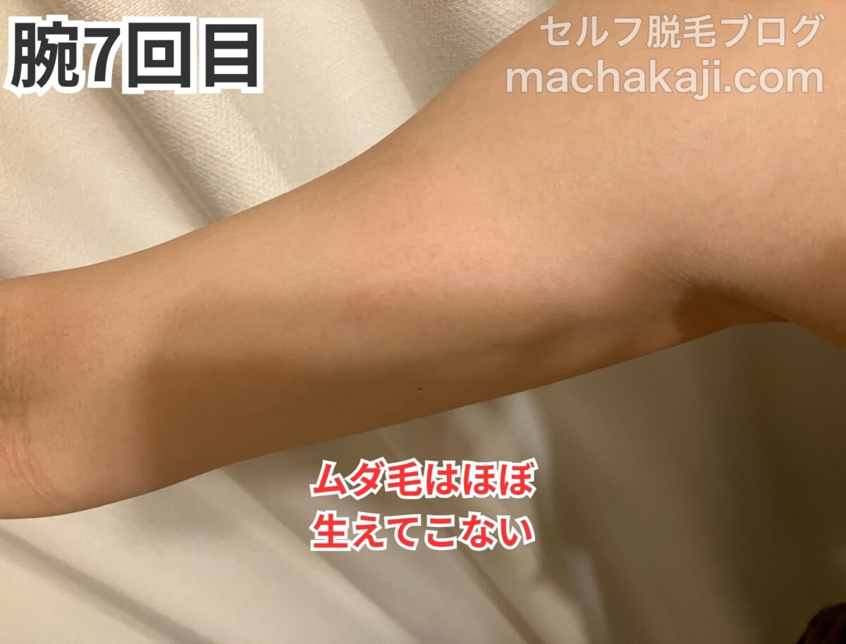 レイボーテヴィーナスで腕を7回照射した経過写真