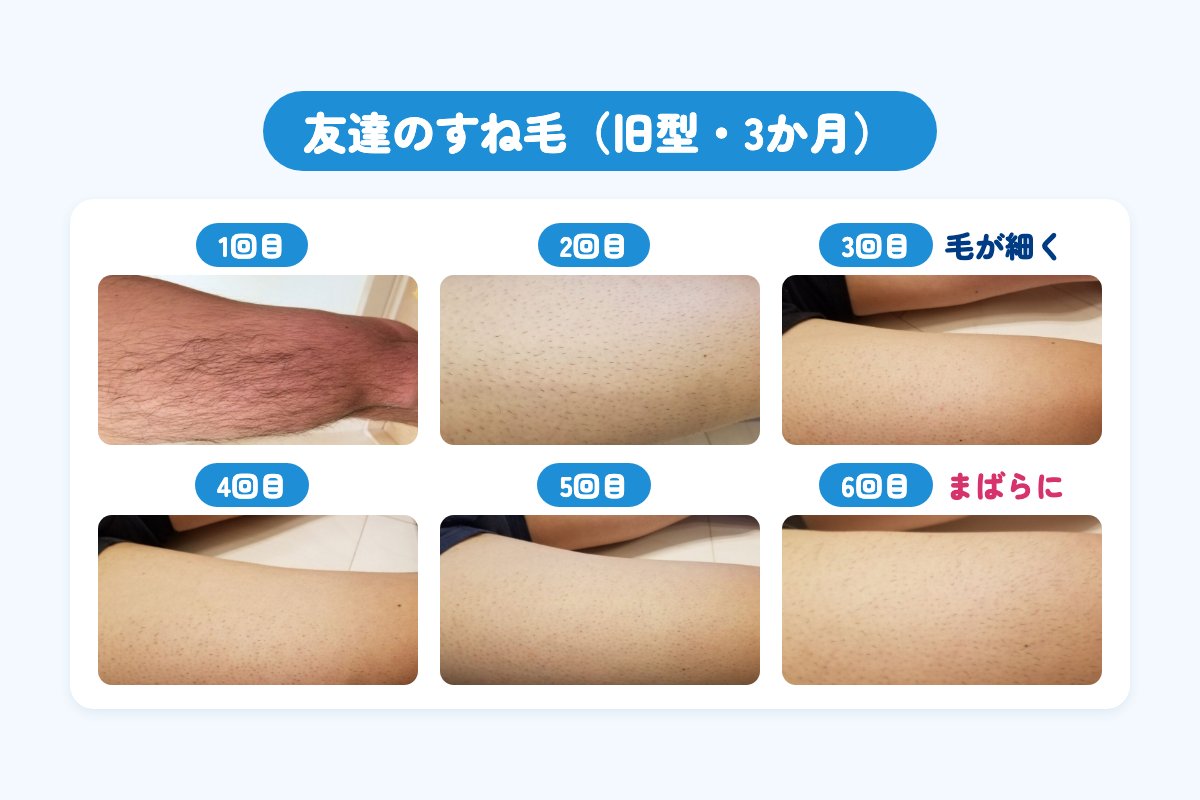 友達のすね毛にトリアの旧型を当てた経過。3回目で毛が細くなり、6回目でまばらになった