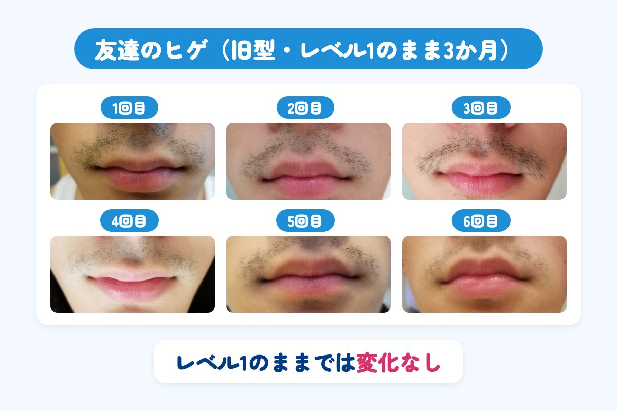 友達のヒゲにトリアの旧型をレベル1のまま3か月当てた経過。変化はなかった